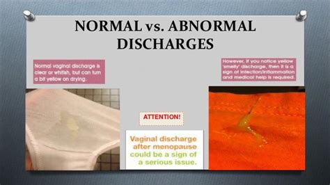 Normal vs. Abnormal Nipple Discharge: Key Differences and。